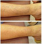 Laser Vein Therapy